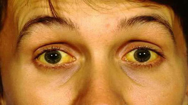 Bệnh nhân bị viêm gan C có thể bị vàng da và mắt