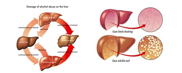 Các giai đoạn phát triển của bệnh gan nhiễm mỡ